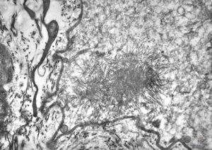 F,25y. | myopathy - atrophic and regenerating muscle cells F,25y. | myopathy - atrophic and regenerating muscle cells